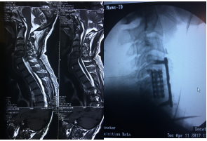 Spine Surgery Program